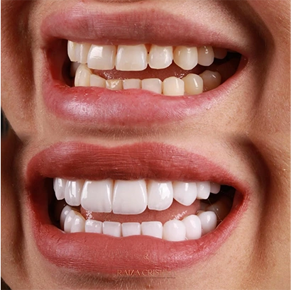 raiza-antes-depois-2