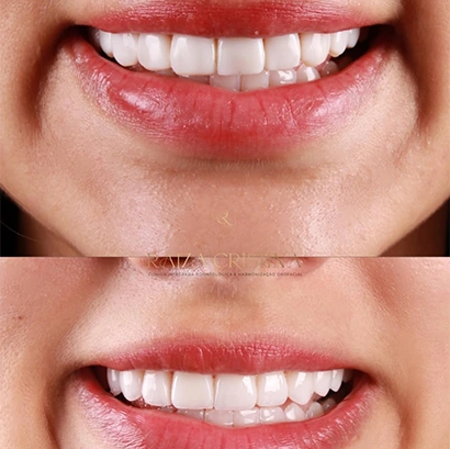 raiza-antes-depois-3