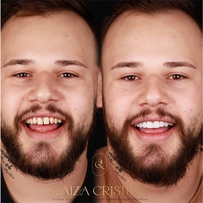 raiza-antes-depois-4