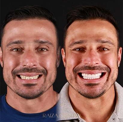 raiza-antes-depois-5