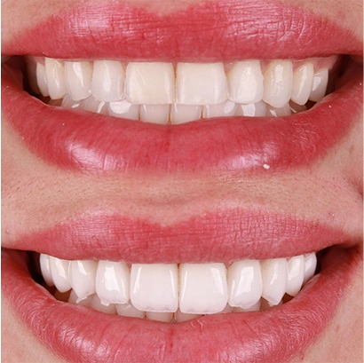 raiza-antes-depois-1